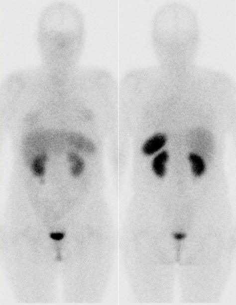 Obr. 1: Celotlov scintigrafie v pedn a zadn projekci 4 hod. po aplikaci OctreoScanu