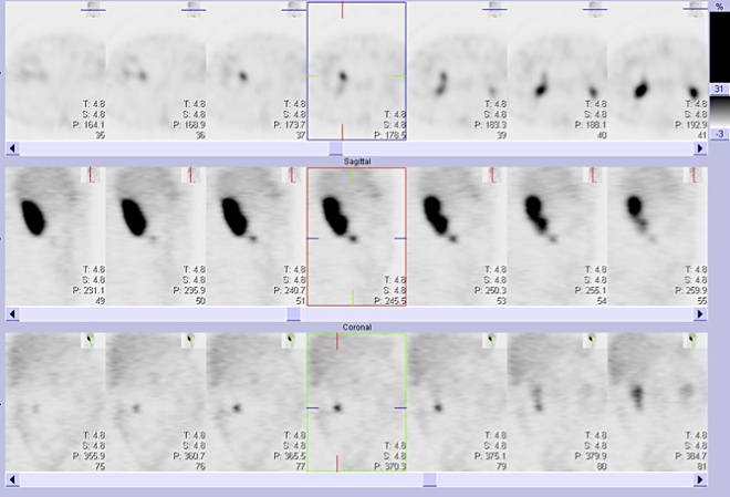 Obr. 2: Tomografická scintigrafie břicha a pánve 4 hod. po aplikaci OctreoScanu