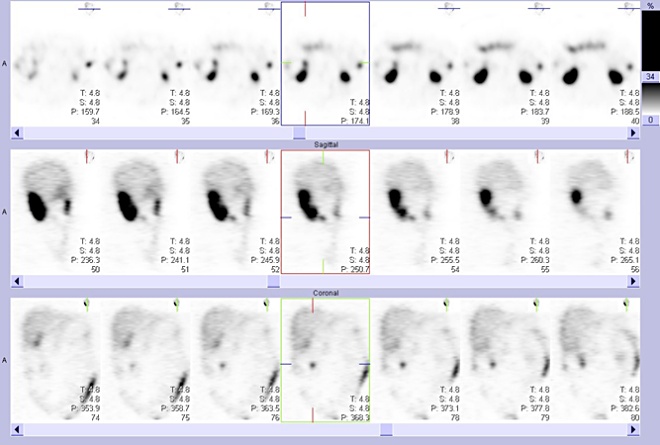 Obr. 4: Tomografick scintigrafie bicha a pnve 24 hod. po aplikaci OctreoScanu