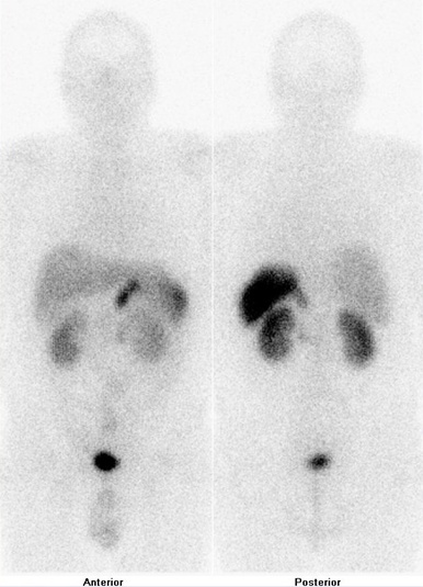 Obr. 1: Celotlov scintigrafie v pedn a zadn projekci 4 hod. po aplikaci OctreoScanu