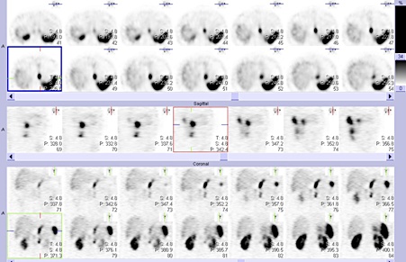 Obr. 2: SPECT bicha 4 hod. po aplikaci OctreoScanu