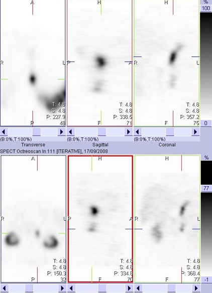 Obr. 3: SPECT bicha 4 hod. po aplikaci OctreoScanu