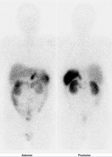 Obr. 4: Celotlov scintigrafie v pedn a zadn projekci 24 hod. po aplikaci OctreoScanu