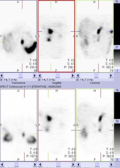 Obr. 5: SPECT bicha 24 hod. po aplikaci OctreoScanu