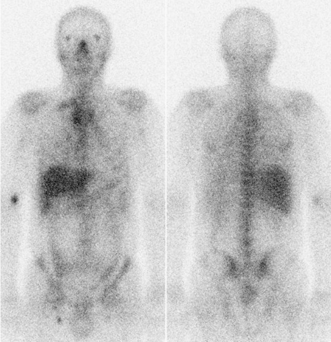 Obr. . 1: Celotlov scintigrafie po aplikaci gallium citrtu v pedn a zadn projekci za 72 hodin po aplikaci
