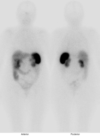 Obr. . 2: Celotlov scintigrafie v pedn a zadn projekci 24 hod. po aplikaci OctreoScanu