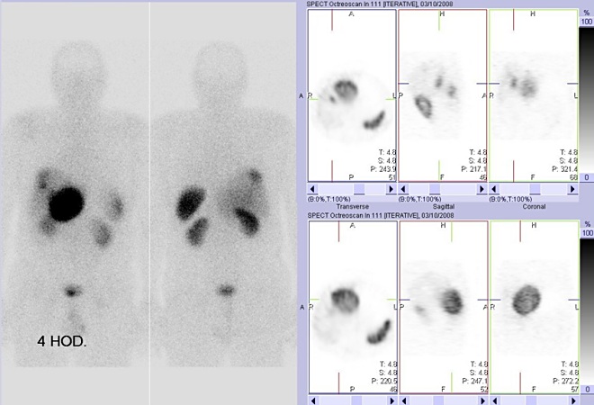 Obr. 1: Vlevo: celotělová scintigrafie v přední a zadní projekci 4 hod. po aplikaci OctreoScanu. Vpravo: tomografická scintigrafie břicha 4 hod. po aplikaci. 