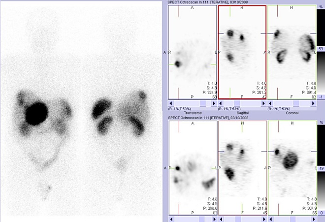 Obr. 2: Vlevo: celotlov scintigrafie v pedn a zadn projekci 24 hod. po aplikaci OctreoScanu. Vpravo: tomografick scintigrafie bicha 24 hod. po aplikaci.