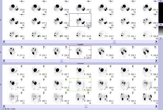 Obr. 3: SPECT bicha 24 hod. po aplikaci OctreoScanu