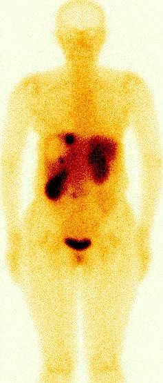 Obr. 1.  Celotlov scintigrafie s 111In-pentetreotidem (OctreoScan), pedn projekce, 4 hodiny po i.v. aplikaci radiofarmaka