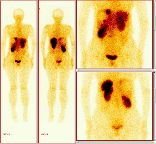 Obr. 2.  Celotlov scintigrafie, pedn a zadn projekce