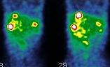 Obr. 4.  SPECT dutiny bin, koronrn ez, metastzy v jtrech