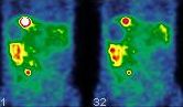 Obr. 5.  SPECT dutiny bin, koronrn ez, primrn karcinoid v klice ilea