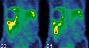 Obr. 6.  SPECT dutiny bin, koronrn ez, nekrotick metastza v pravm jaternm laloku