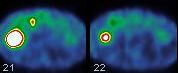 Obr. 7.  SPECT dutiny bin, transverzln ez, primrn karcinoid v klice ilea