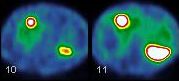 Obr. 8.  SPECT dutiny bin, transverzln ez, metastzy v jtrech