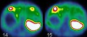 Obr. 9.  SPECT dutiny bin, transverzln ez, nekrotick metastza v pravm jaternm laloku