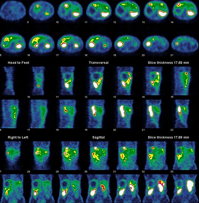 Obr. 3.  SPECT dutiny bin