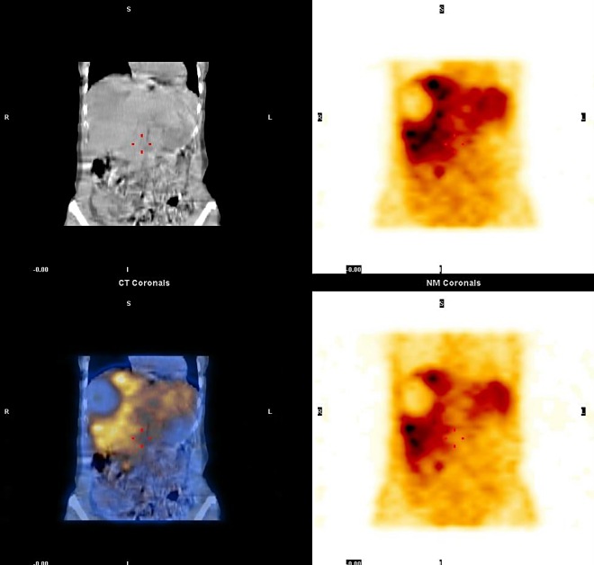 Obr. 10.  SPECT, CT, SPECT/CT dutiny bin, koronrn ez