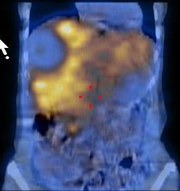 Obr. 13.  SPECT/CT dutiny bin, koronrn ezy