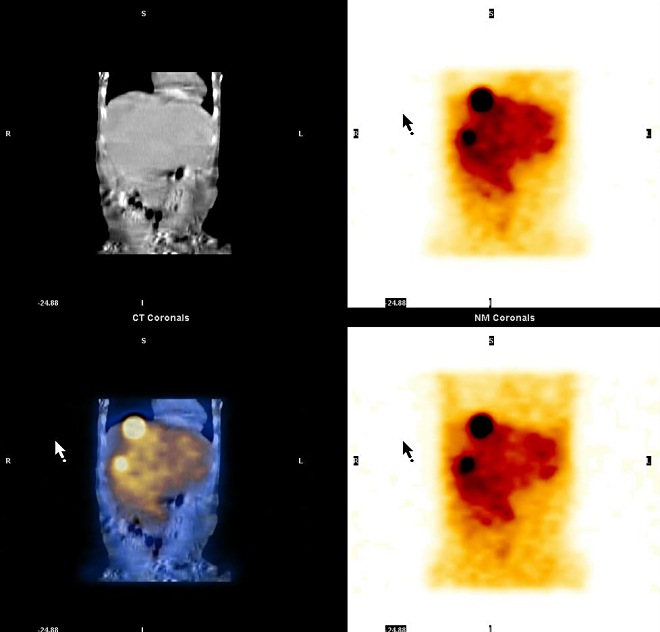 Obr. 14.  SPECT, CT, SPECT/CT dutiny bin, koronrn ezy