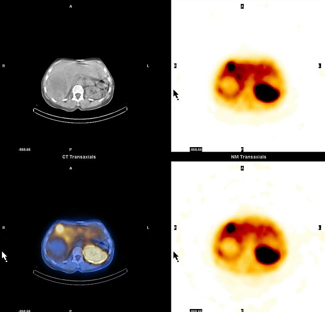 Obr. 18.  SPECT, CT, SPECT/CT dutiny bin, transverzln ezy