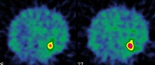 Obr. 3.  SPECT dutiny hrudn, transverzln ezy