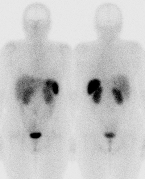 Obr. . 1: Celotlov scintigrafie v pedn a zadn projekci 4 hod. po aplikaci OctreoScanu