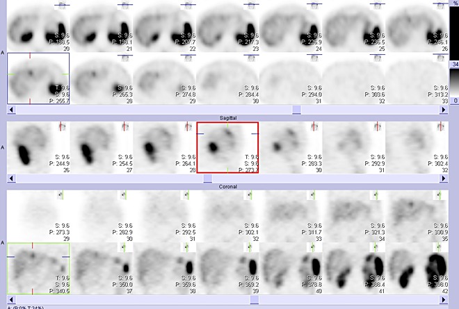 Obr. . 2: Tomografick scintigrafie jater 4 hod. po aplikaci OctreoScanu