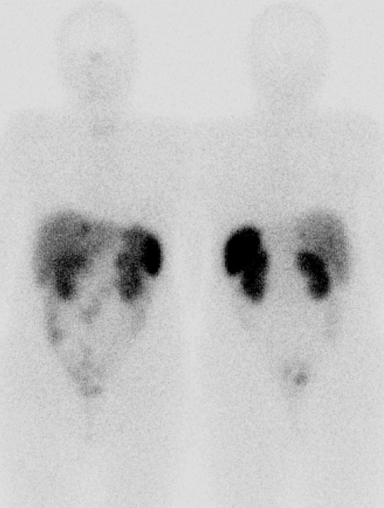 Obr. . 3: Celotlov scintigrafie v pedn a zadn projekci 24 hod. po aplikaci OctreoScanu