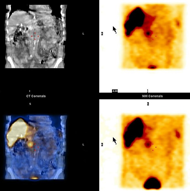 Obr. 2. SPECT, CT a SPECT/CT, koronrn ezy