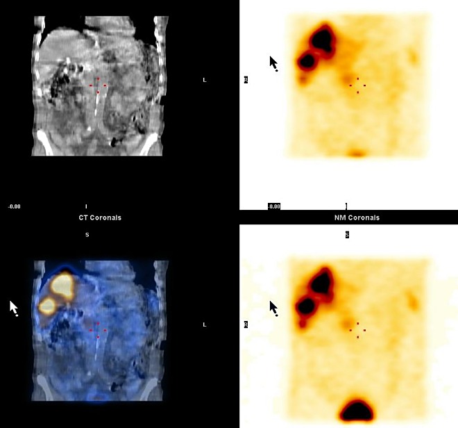 Obr. 3. SPECT, CT a SPECT/CT, koronrn ezy