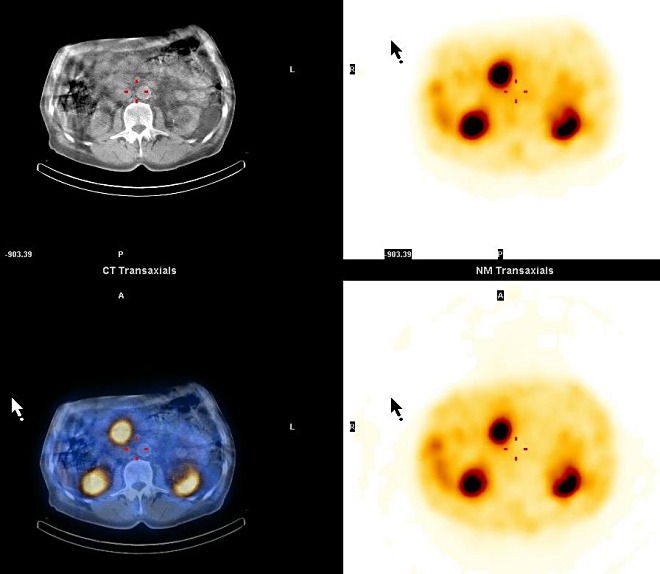 Obr. 4. SPECT, CT a SPECT/CT, transverzln ezy