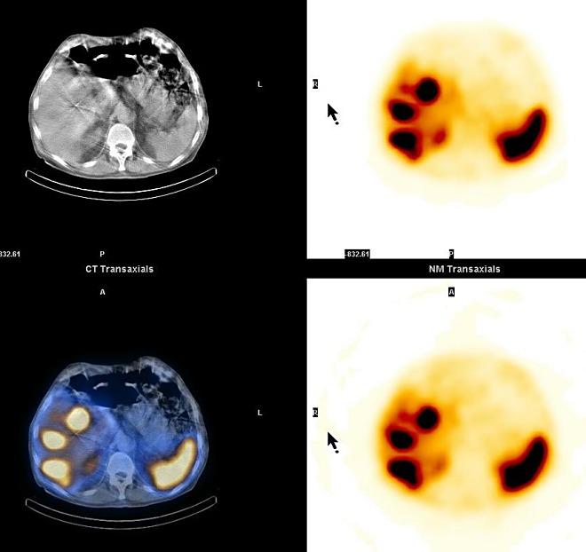 Obr. 5. SPECT, CT a SPECT/CT, transverzln ezy