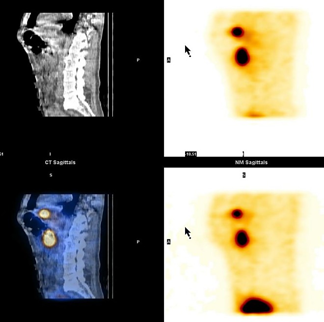 Obr. 6. SPECT, CT a SPECT/CT, sagitln ezy