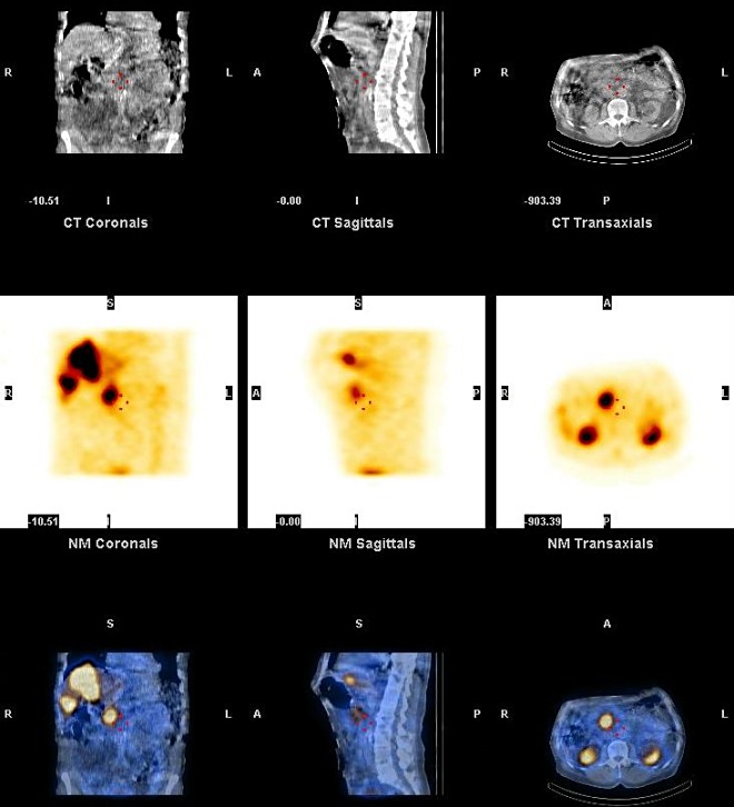 Obr. 7. SPECT, CT a SPECT/CT, koronrn, sagitln a transverzln ezy