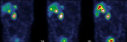 Obr. 9. SPECT dutiny bin, koronrn ezy