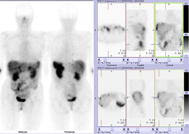 Obr. 2: Celotlov scintigrafie (vlevo) a SPECT bicha a doln sti hrudnku 4 hod. po aplikaci OctreoScanu