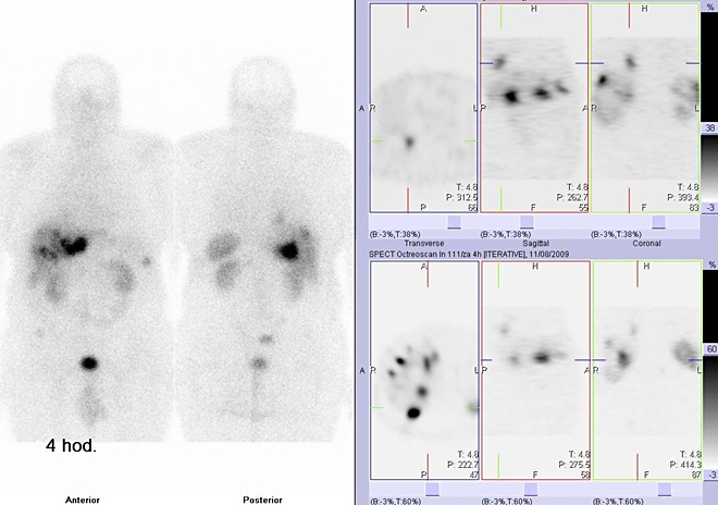 Obr..1: Celotlov scintigrafie v pedn a zadn projekci a tomografick (SPECT) scintigrafie bicha 4 hod. po aplikaci OctreoScanu