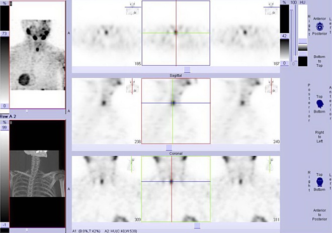 Obr. . 3: Tomografick scintigrafie krku 3 hodiny po aplikaci radioindiktoru