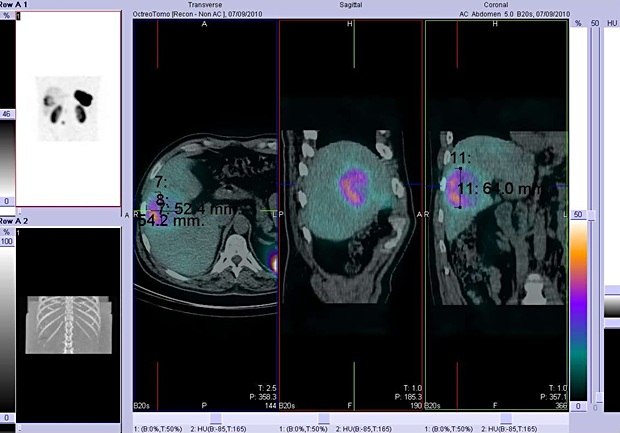 Obr. . 4: Fze obraz SPECT a CT. Vyeten 4 hod. po aplikaci radioindiktoru