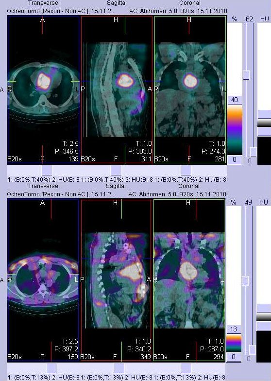 Obr. . 3: Fze obraz SPECT a CT - hrudnk. Vyeten 4 hod. po aplikaci radioindiktoru. Vlevo transverzln  ezy, uprosted sagitln ezy, vpravo ezy koronrn. Zameno na dv loiska v plicch.