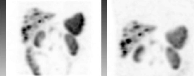 Obr. . 4: Tomografick scintigrafie SPECT. Vyeten 4 a 24 hod. po aplikaci radioindiktoru. Vlevo vyeten za 24 hod., vpravo vy. za 4 hod.
