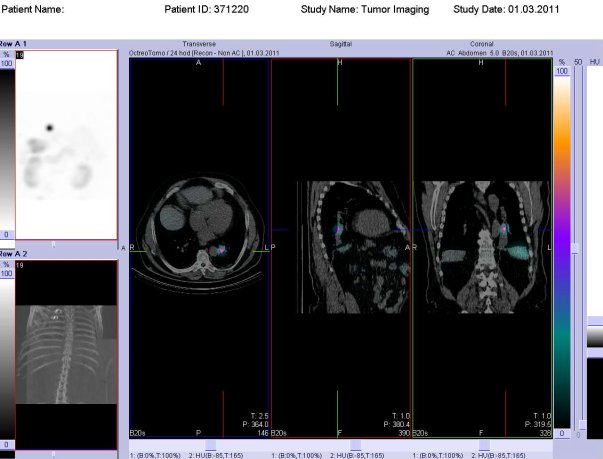 Obr. . 5: Fze obraz SPECT a CT. Vyeten 24 hod. po aplikaci radioindiktoru. Vlevo transverzln ez, uprosted sagitln ez, vpravo ez koronrn. Zameno na loisko v lev plci.