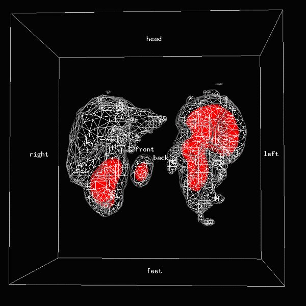 Obr.3: Scintigrafie pomoc 111In-OctreoScan metodou SPECT v 3D zobrazen s patologickou depozic radiofarmaka v oblasti epigastria.