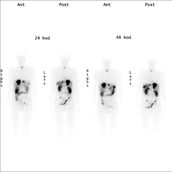 Obr.1: Scintigrafie pomoc 111In-OctreoScan metodou whole body za 24 a 48 hodin po aplikaci radiofarmaka s  patologickmi loiskovmi depozicemi radiofarmaka v oblasti jater a skeletu.