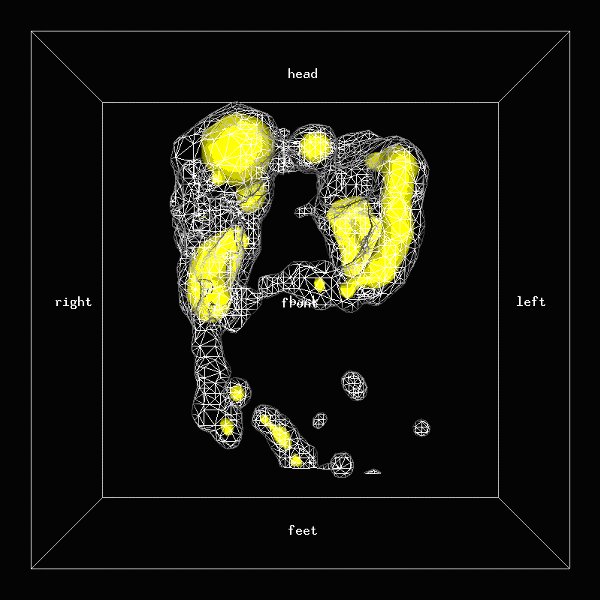 Obr.3: Scintigrafie pomoc 111In-OctreoScan metodou SPECT v 3D zobrazen s  patologickmi loiskovmi depozicemi radiofarmaka v oblasti jater a skeletu.