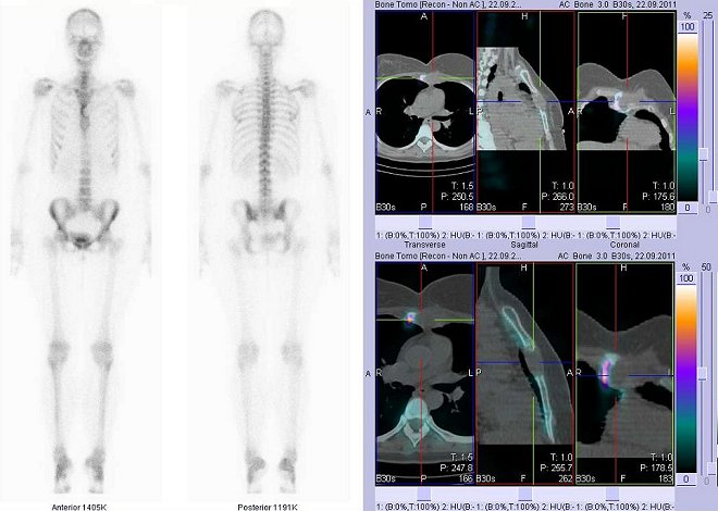 Obr. . 2: Celotlov scintigrafie v pedn a zadn projekci a fze obraz SPECT a CT.  Vpravo zameno na velk osteolytick zeloisko ve sternu. ezy transverzln, ezy sagitln a ezy koronln.