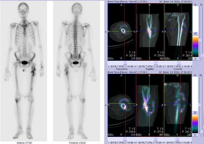 Obr. .3: Celotlov scintigrafie v pedn a zadn projekci a fze obraz SPECT a CT.  Vpravo zameno na loisko v horn sti levho stehna. ezy transverzln, ezy sagitln a ezy koronln.