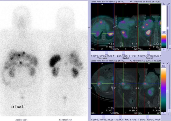 Obr. . 4: Celotlov scintigrafie v pedn a zadn projekci a fze obraz SPECT a CT. Vyeten 5 hod. po aplikaci radioindiktoru. Vpravo nahoe: zameno na loisko v pravm jaternm laloku. Vpravo dole: zameno na dal loisko v pravm jaternm laloku.